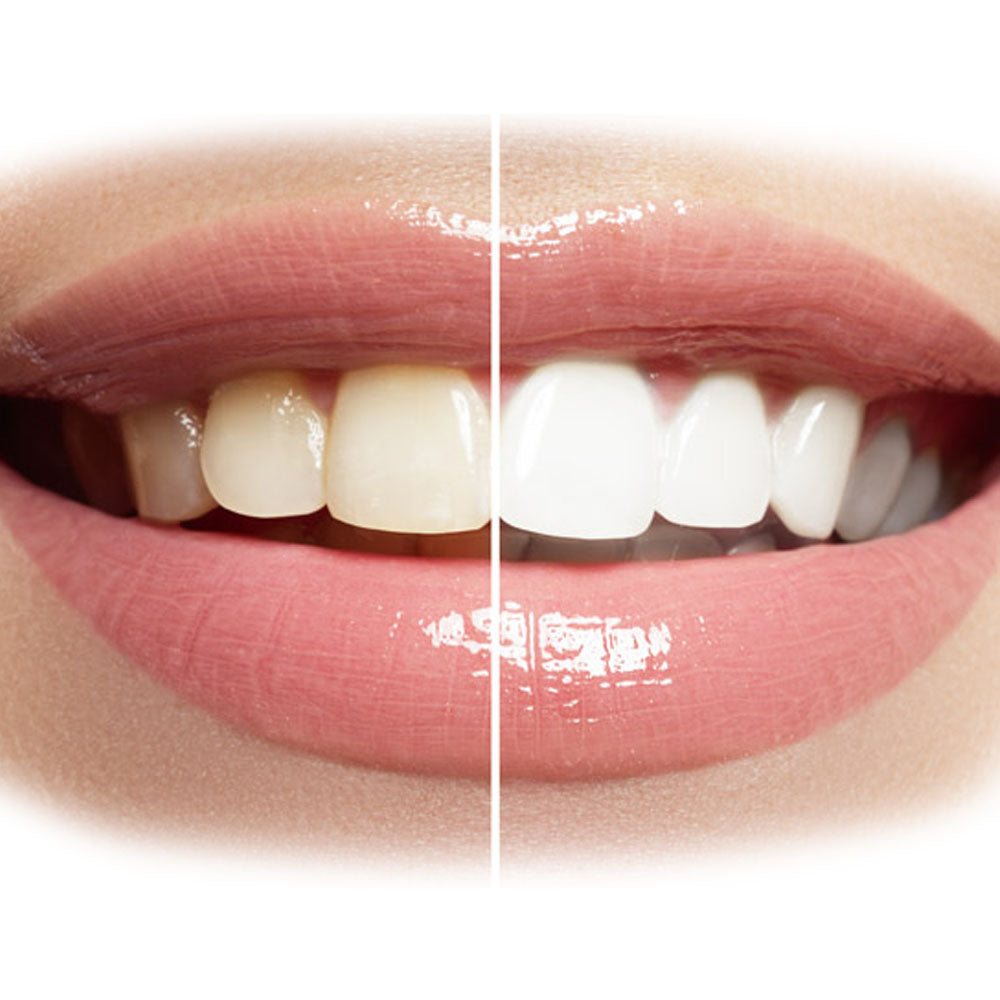In-Office Teeth Whitening Buy 2 get 1 FREE