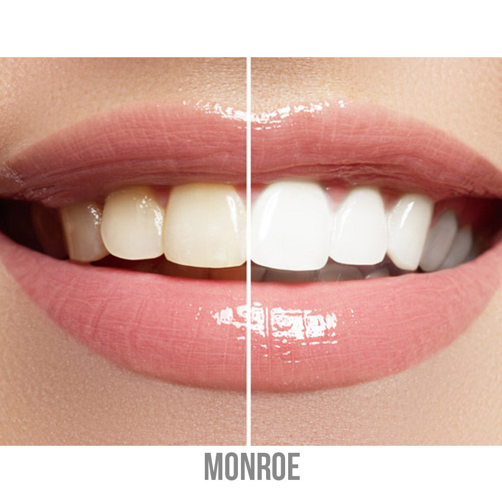 In-Office Teeth Whitening